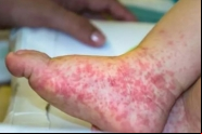 'Gripe do tomate': novo v